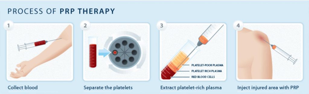 plasma-rico-en-plaquetas